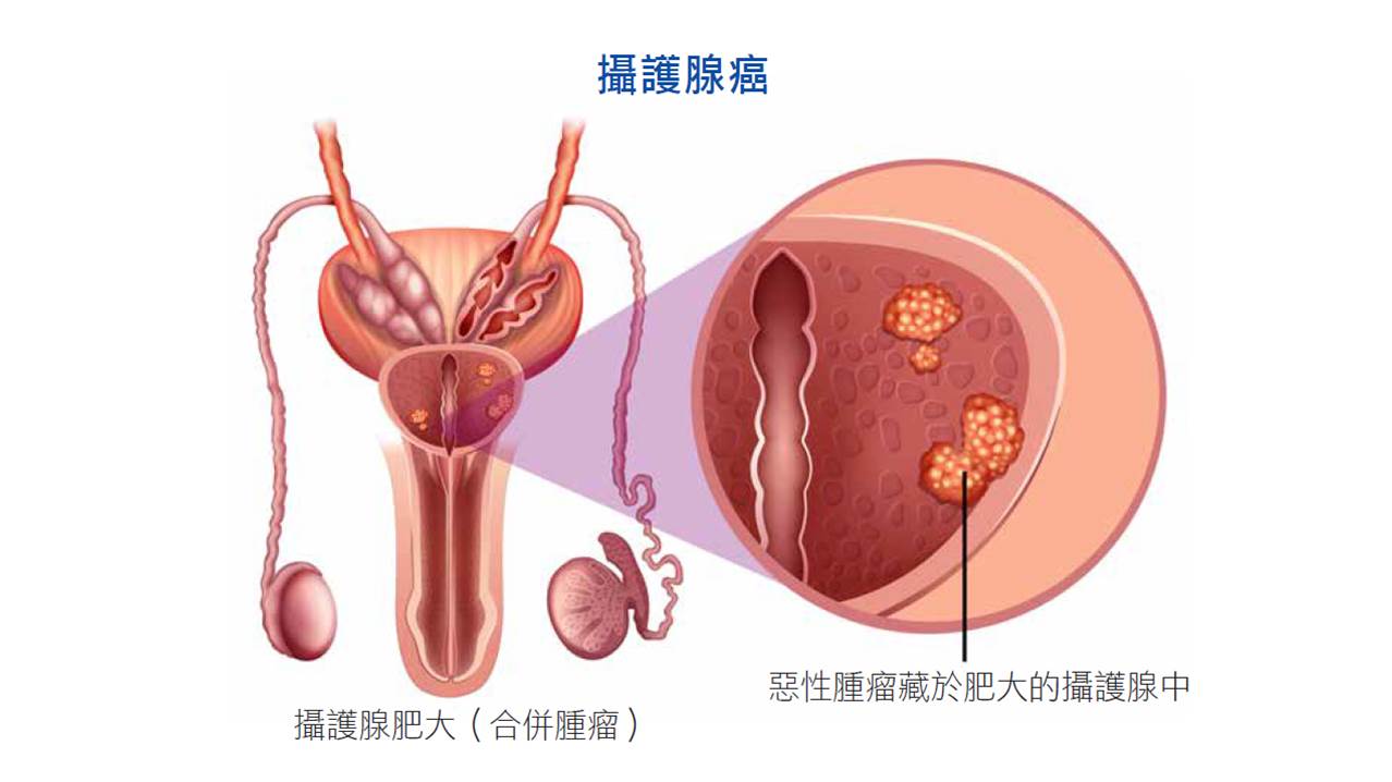 診斷男性 長壽癌 攝護腺癌檢查新趨勢 永越健康管理中心